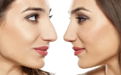 Bulbous Nose Job Before and After: Transforming Your Appearance