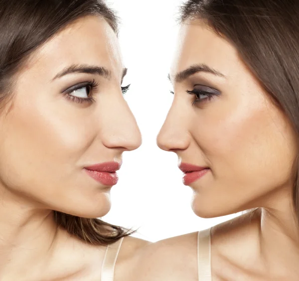 Bulbous Nose Job Before and After: Transforming Your Appearance